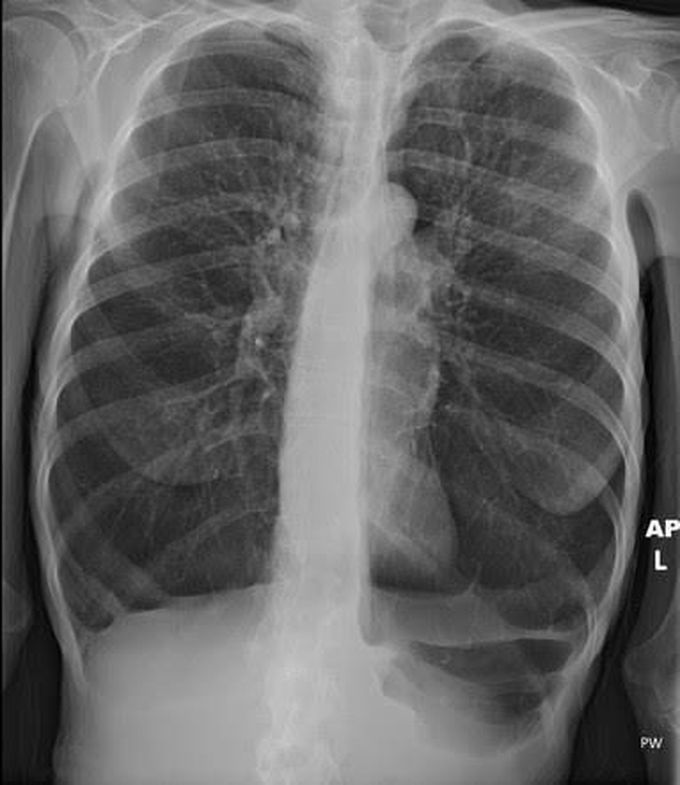 Complications of emphysema