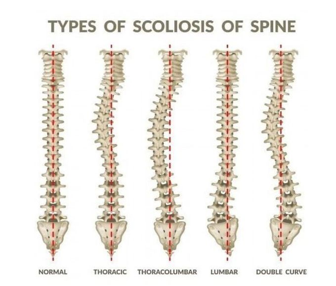 Types of Scoliosis