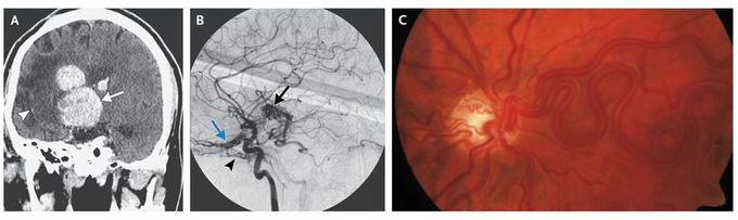 Intracranial Arteriovenous Malformation
