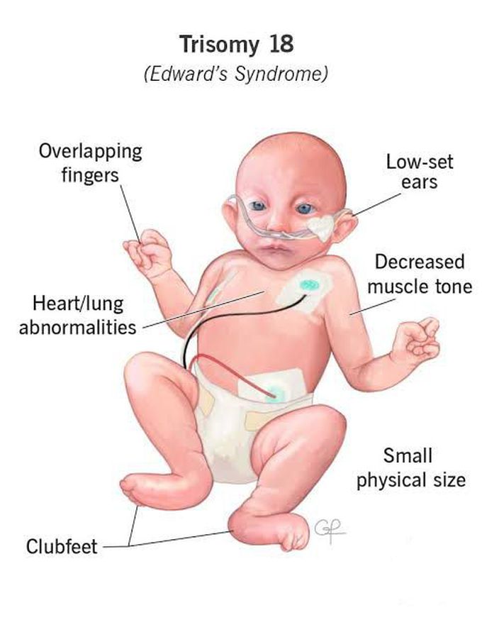 These are the symptoms of Edward's syndrome