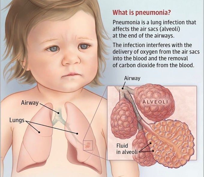 Pneumonia