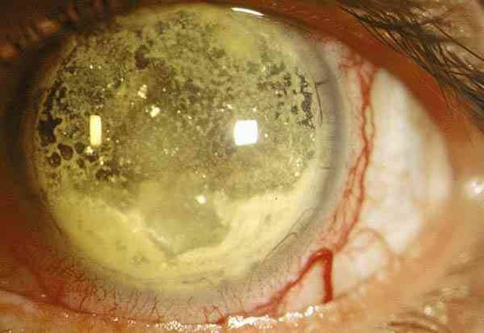 Granulomatous endophthalmitis related to trauma