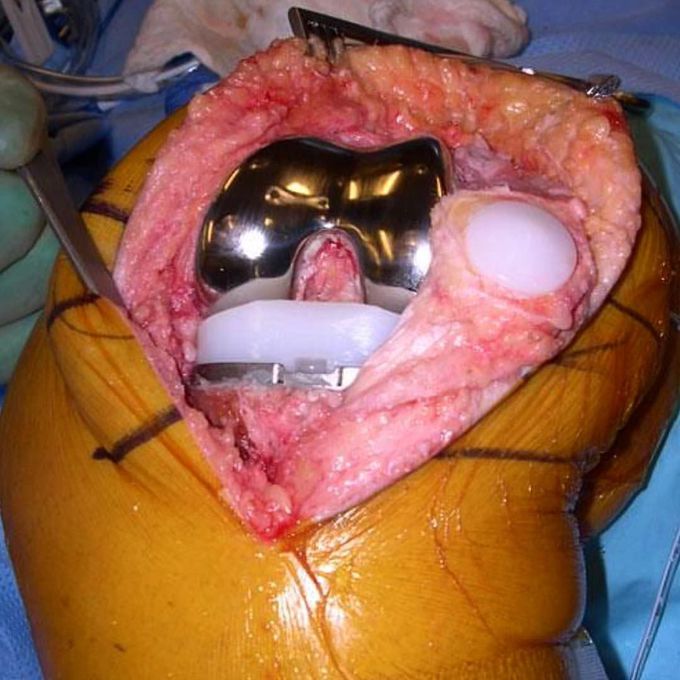 Total knee replacement