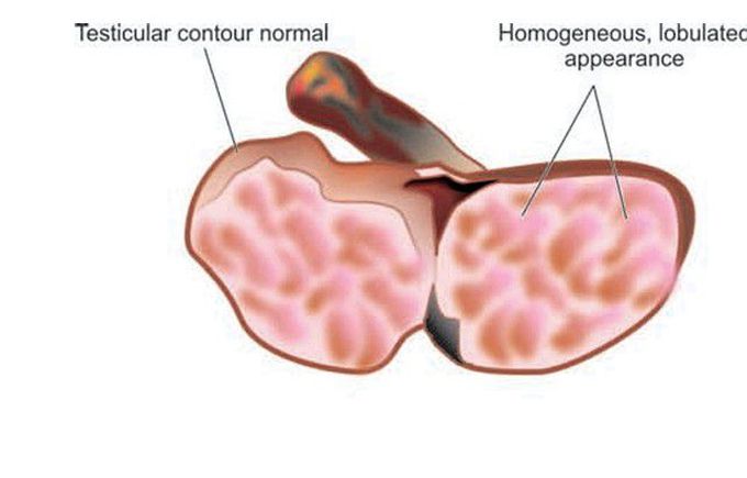 Seminoma testis