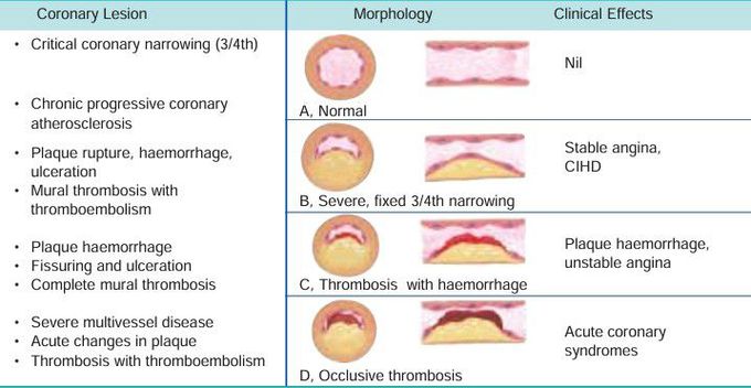 Ischemic heart disease