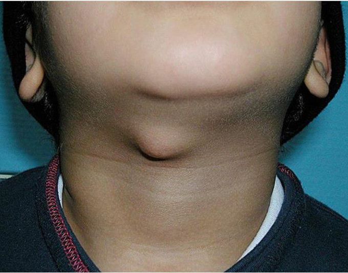 Identify this swelling in the neck