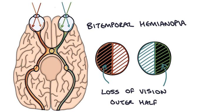 Understanding Bitemporal Hemianopia