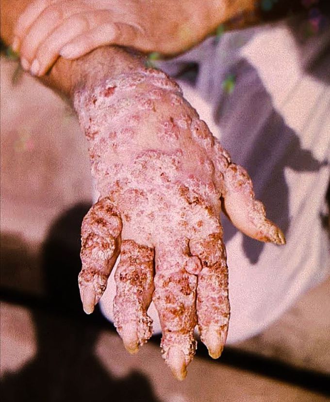 Picture depicting Chromoblastomycosis 