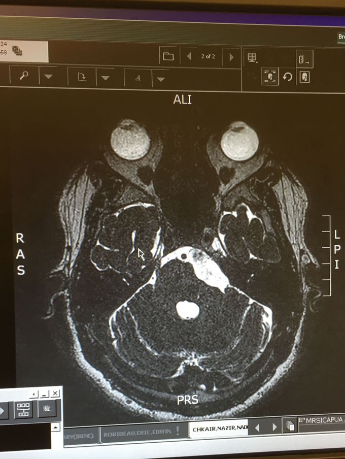 Epidermoid cyst