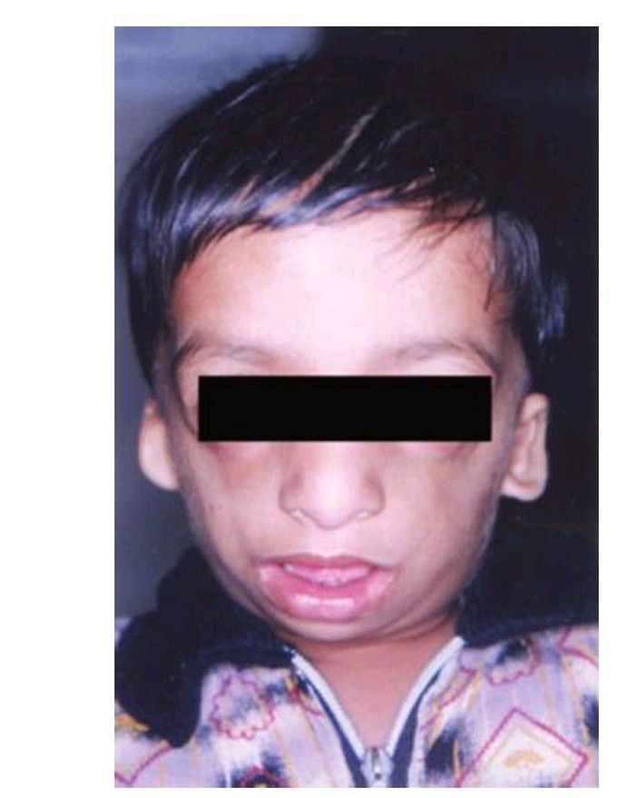 Treacher collin’ s syndrome