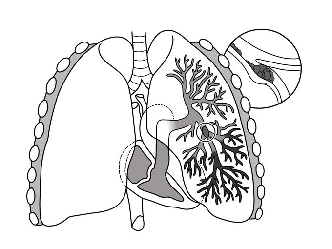 Causes of pulmonary embolus