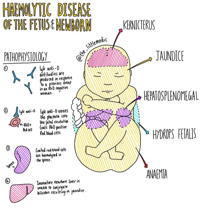 Haemolytic Disease of the fetus and newborn