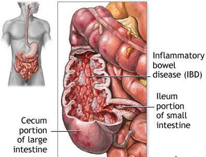 Why does Crohn's disease occur?
