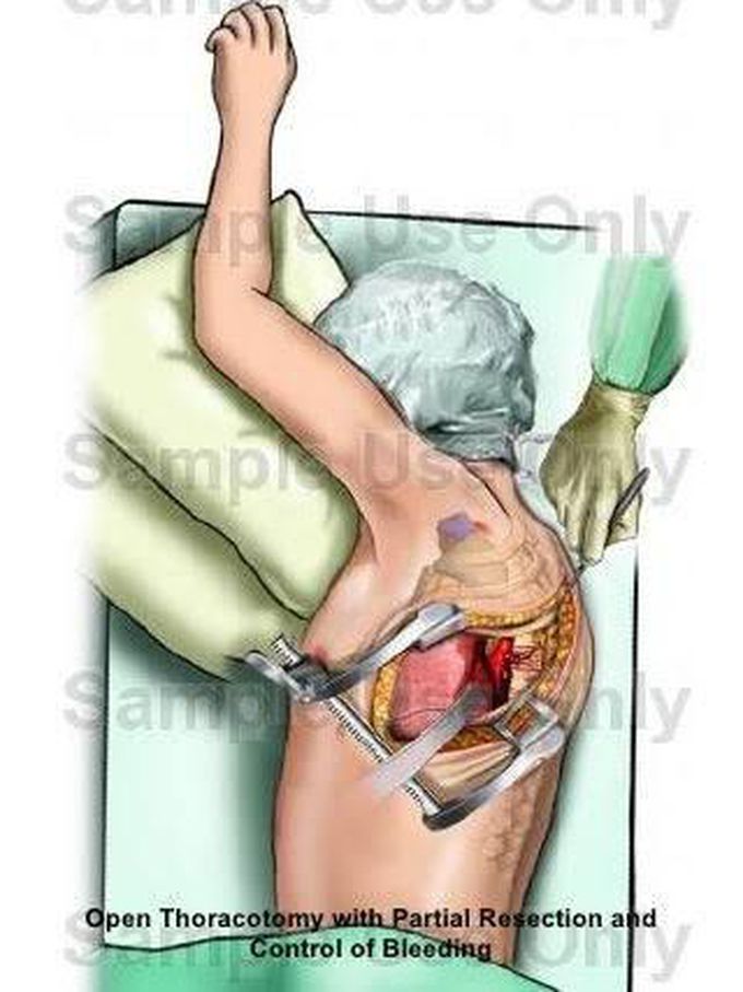 Thoracotomy