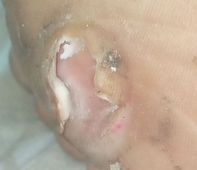 Is this a foot corn?
