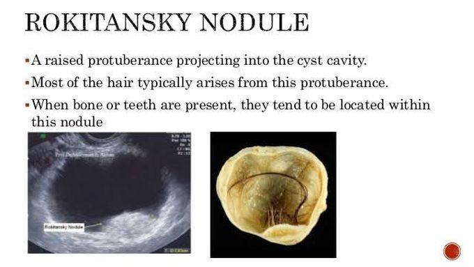 Rokitansky nodules