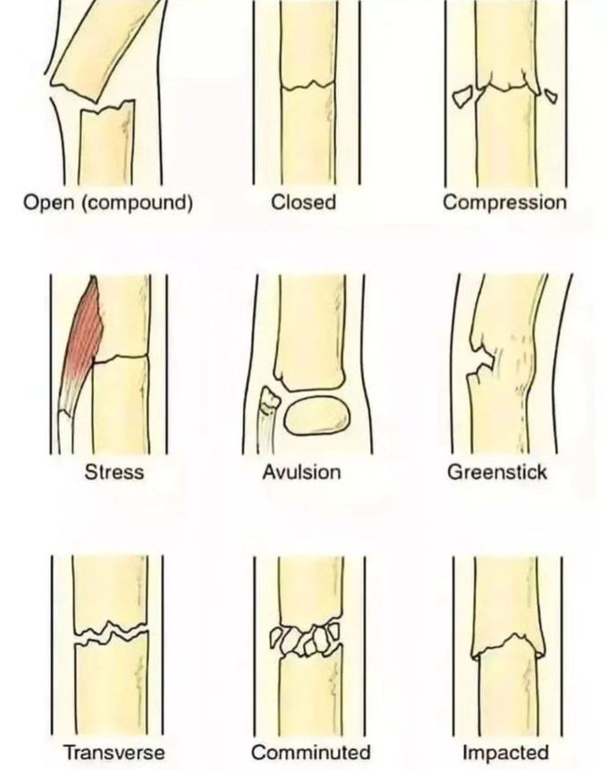 Types of Fractures