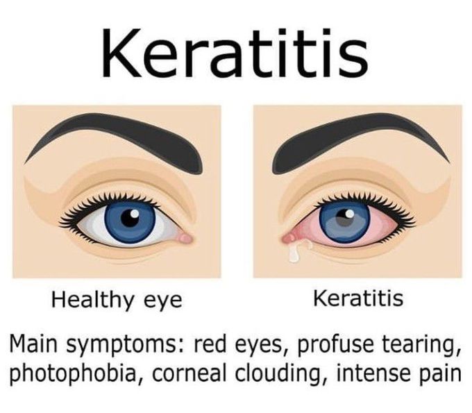 Keratitis/ Inflammation of eye