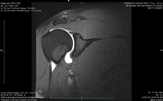 MRI Artgrogram