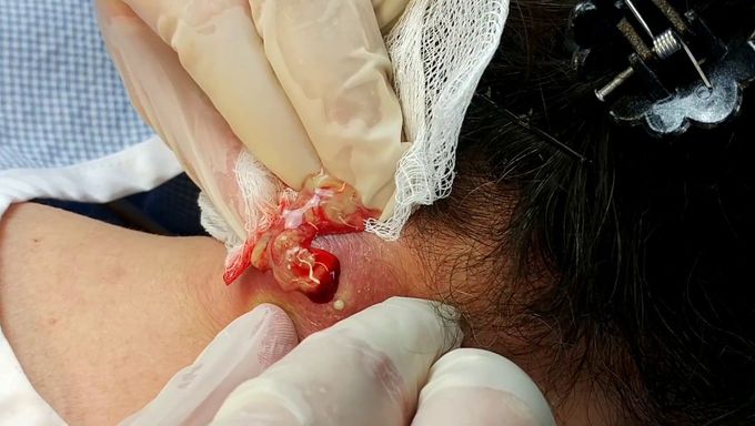 Drainage of Infected Epidermal Cyst
