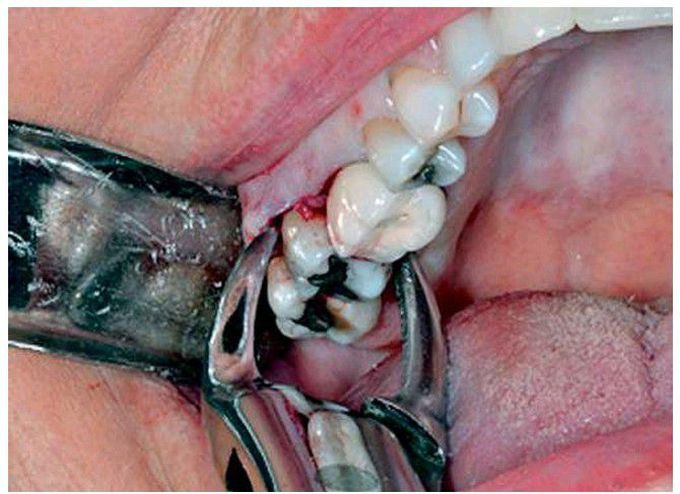 Placement of extraction forceps