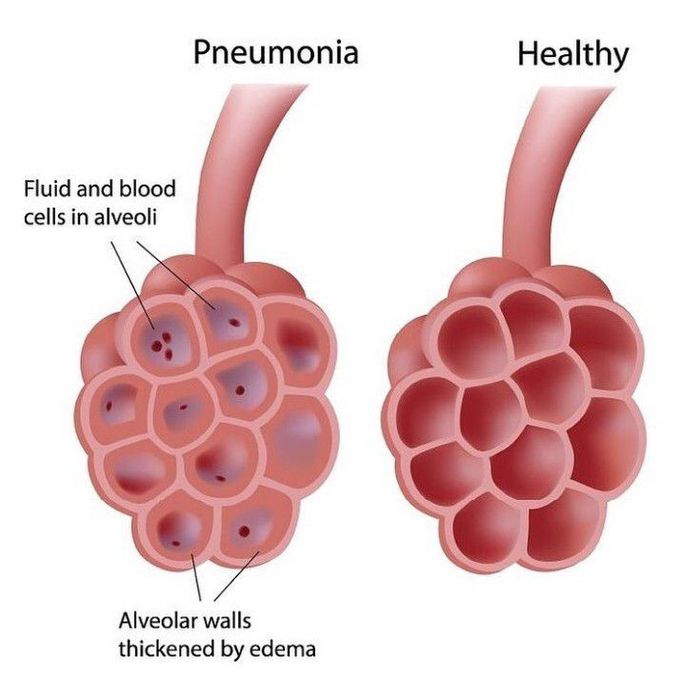 Difference between healthy and pneumonic Alveoli