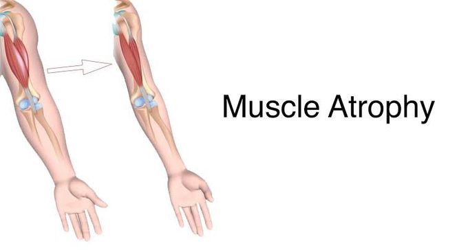 Symptoms of muscle wasting