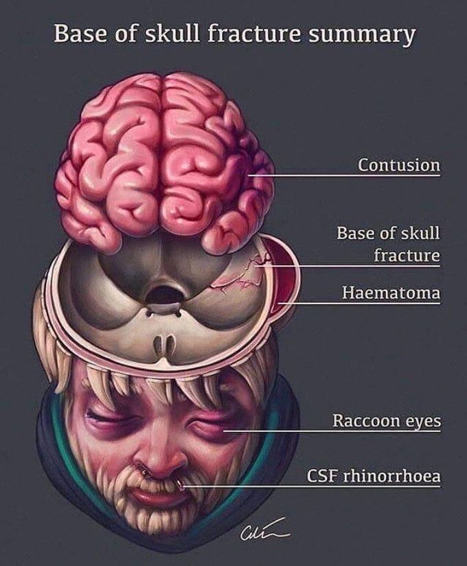 Base of skull fracture summary