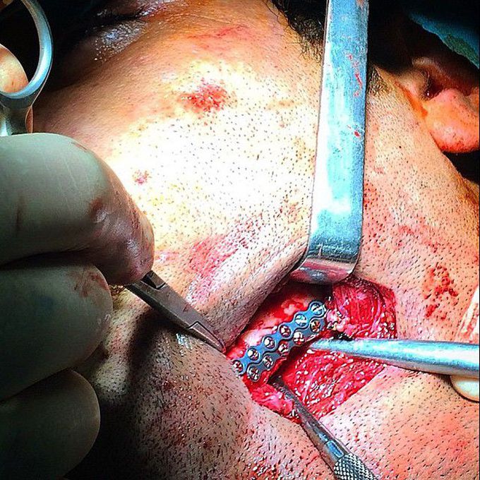 Mandibular angle fracture