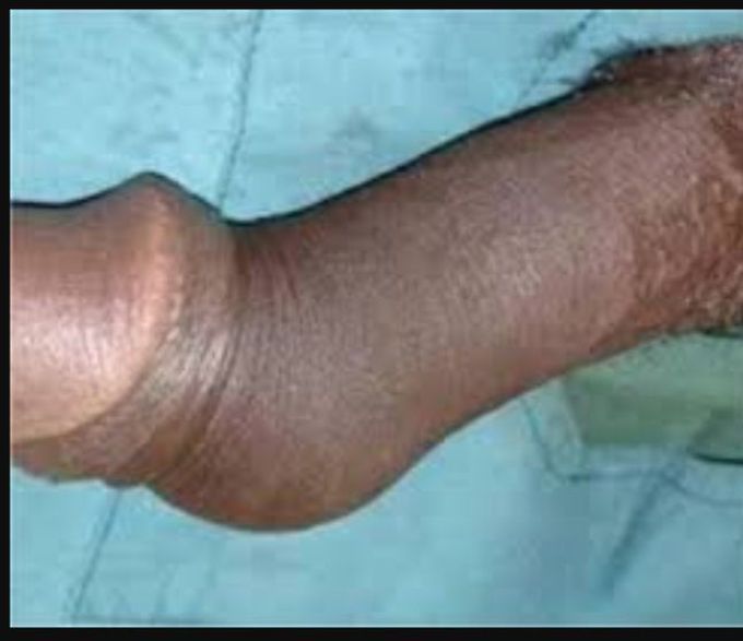 What is a penile fracture?