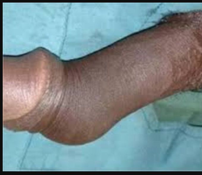 penile fracture symptoms photos