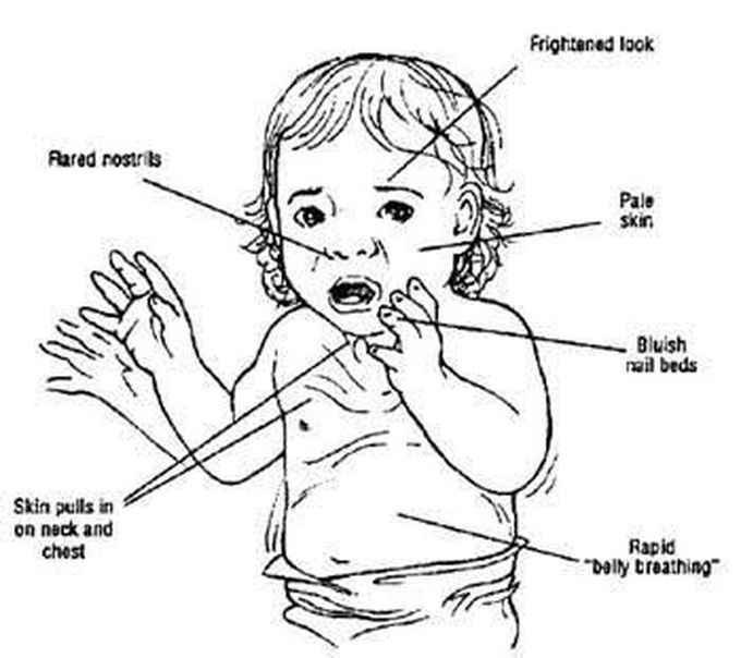 These are the signs of infant respiratory distress syndrome