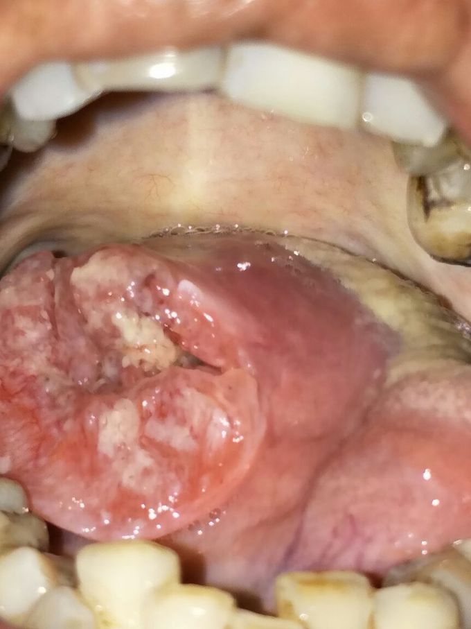 Squamous  cell carcinoma  of lateral border of tongue