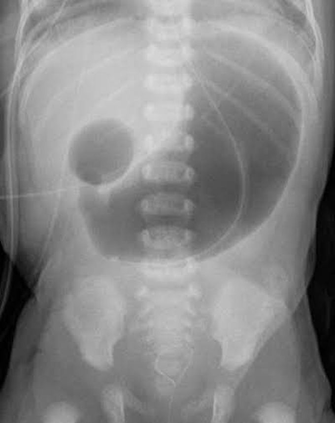Double bubble sign on X-ray