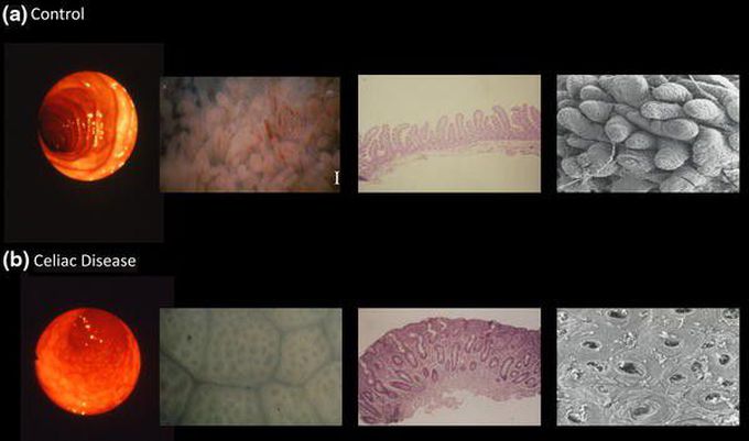 Gluten-Sensitive Enteropathy AKA Celiac Disease