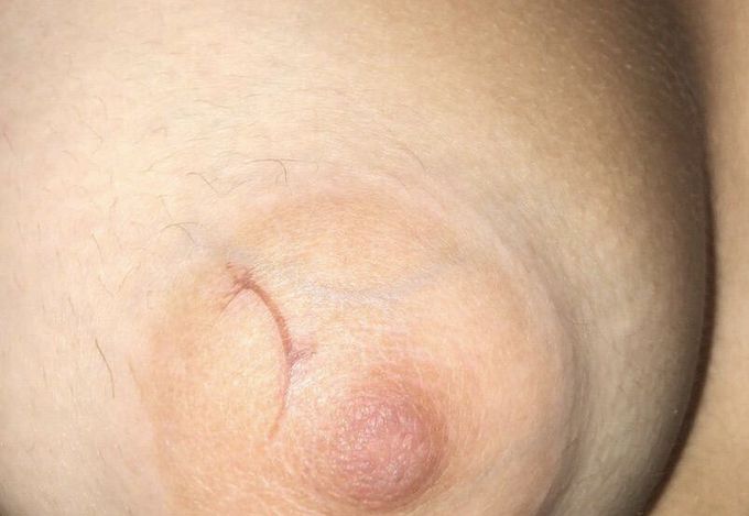 Unknown spot on left areola mammae