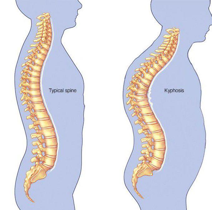 KYPHOSIS