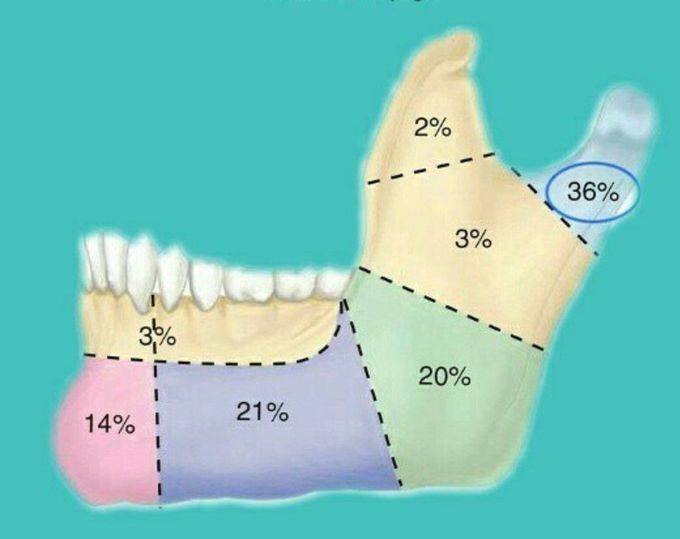 Most common sites for mandibular fracture.