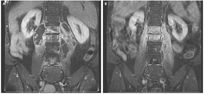 Spinal Brucellosis