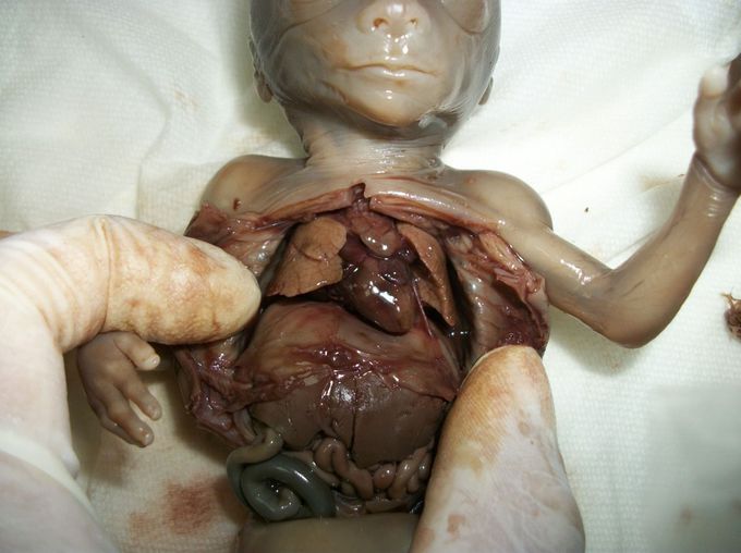 FETAL DISSECTION