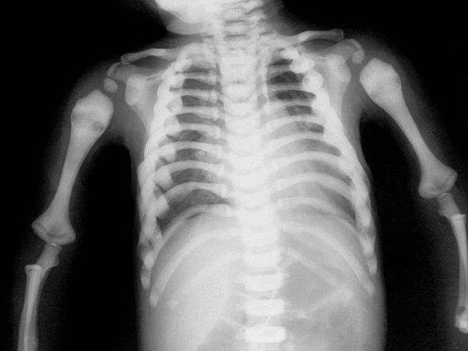 Osteopetrosis