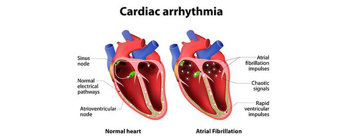 Heart arrhythmias