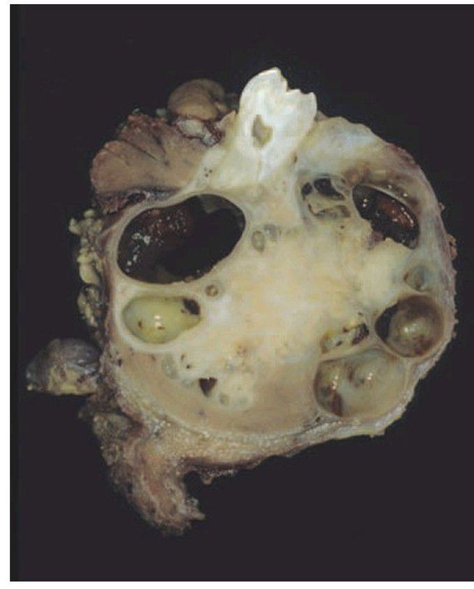 Ameloblastoma