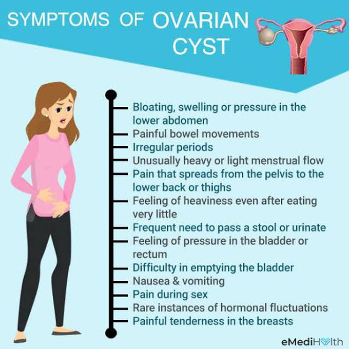 Ovarian cyst symptoms