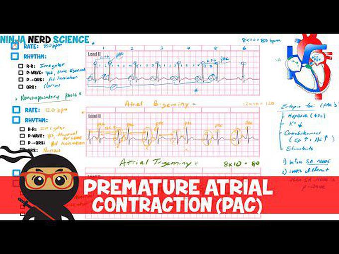 Premature Atrial contraction