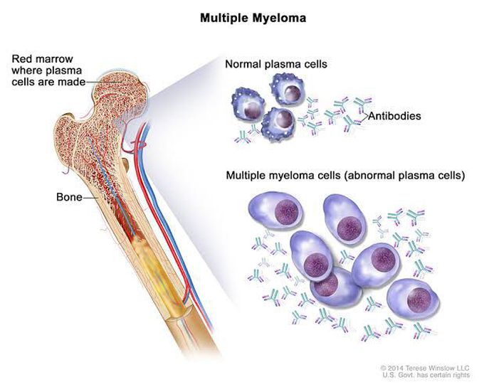 Symptoms of multiple myeloma