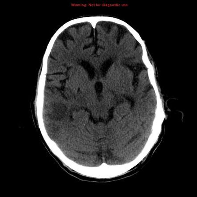 Features of Ischemic Stroke on CT Scan