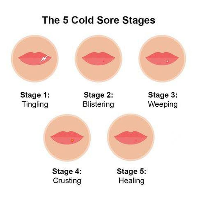 Cold Sores Complications Medizzy