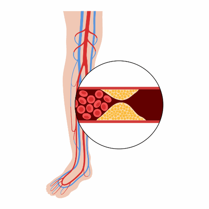 Treatment of intermittent claudication