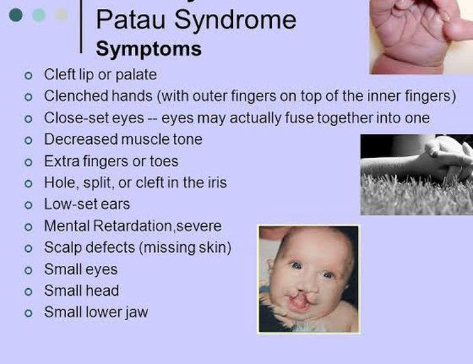 These are the symptoms of Patau syndrome
